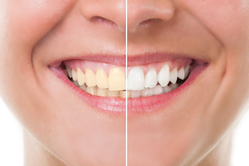 Teeth Whitening in National City